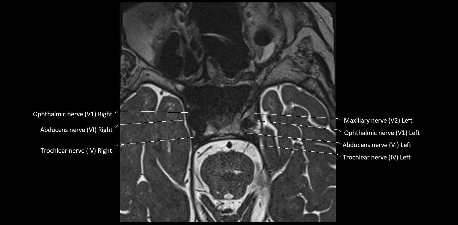 Cranial nerve anatomy axial MRI 3T image 34.webp